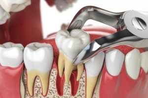 mock-up for tooth extractions